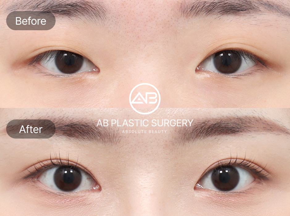 目尻切開・目下切開のビフォーアフター写真。AB美容外科韓国による症例で、自然に大きな目元を実現した二重整形、目元整形の効果