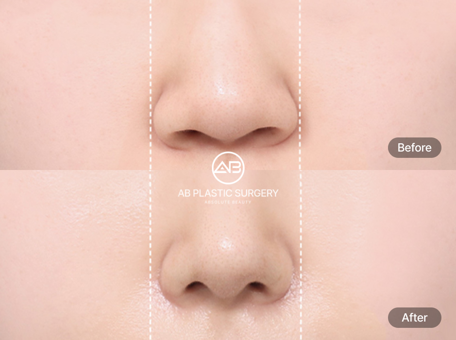 小鼻縮小の前後写真、鼻翼の広がりを整えバランスの良い鼻を実現したAB美容外科韓国の症例