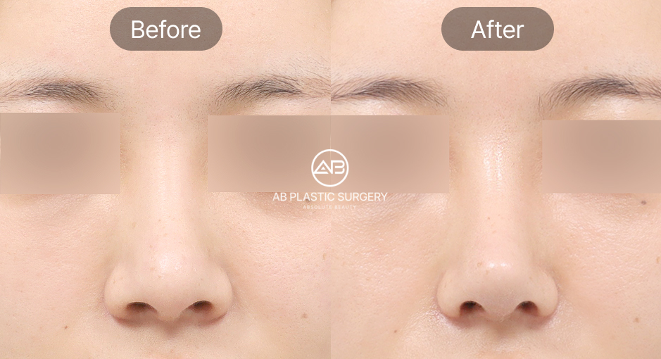 小鼻縮小の前後写真、鼻の穴を小さくし顔全体のバランスを整えたAB美容外科韓国の症例