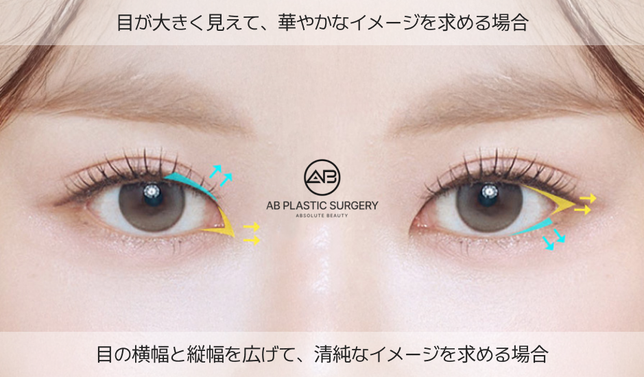 目尻切開・目下切開デザイン比較図。目の横幅と縦幅を広げて華やかまたは清純な目元を実現するAB美容外科韓国の目元整形