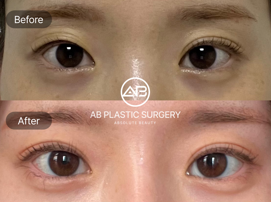 韓国美容整形 AB美容外科韓国 二重整形 前後写真 自然でぱっちりした目元を実現 ダウンタイムが短い人気施術