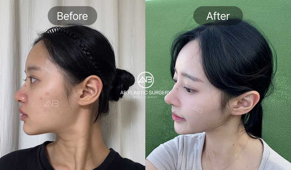 韓国美容ツアー 鼻整形 前後写真 AB美容外科韓国 自然で整った横顔ラインの変化