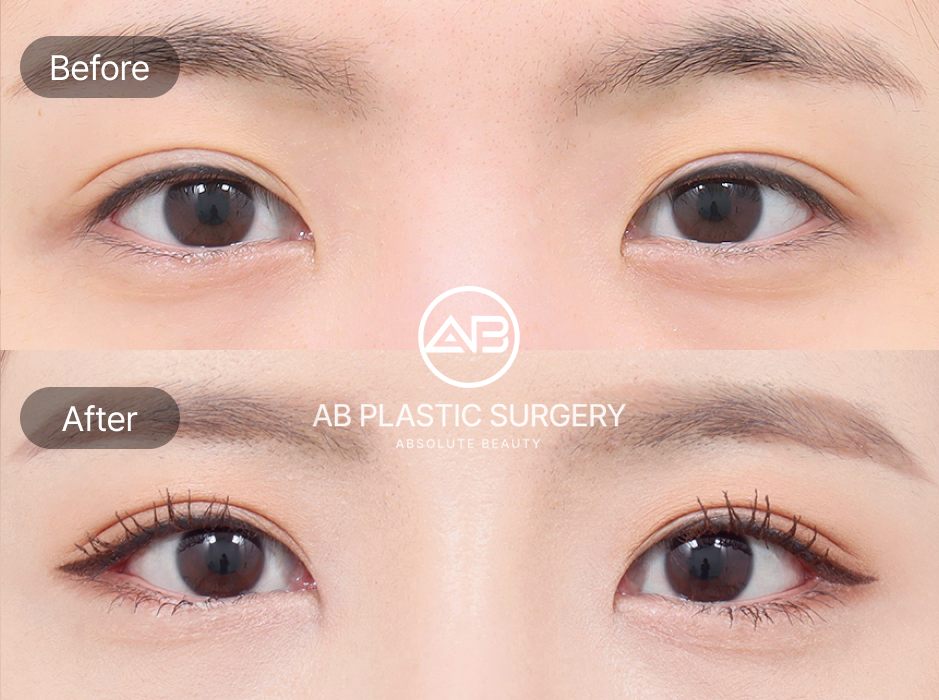 目尻切開・目下切開のビフォーアフター写真。AB美容外科韓国による施術で横幅と縦幅を同時に広げ、自然で大きな目元を実現