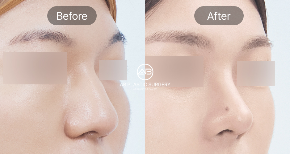 韓国美容整形 AB美容外科韓国 隆鼻術 鼻整形 前後写真 自然でバランスの取れた鼻ライン 人気施術