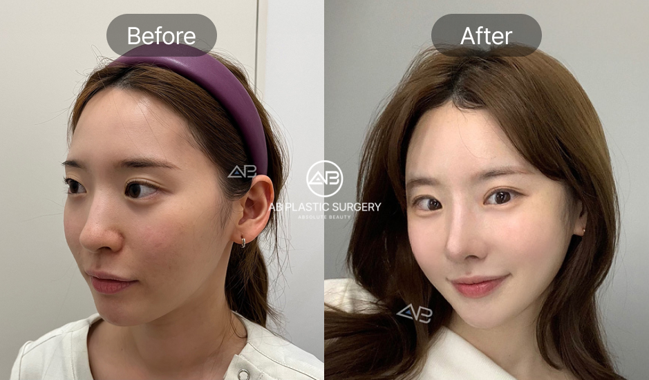 小鼻縮小の前後写真、笑ったときに横に広がる小鼻を改善し顔全体のバランスを整えたAB美容外科韓国の症例