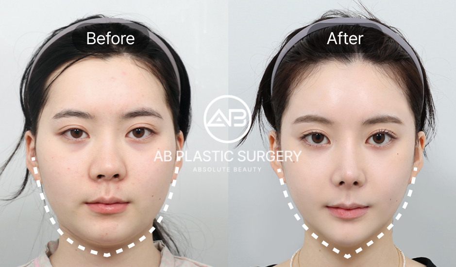 韓国美容整形 AB美容外科韓国 輪郭整形 小顔矯正 前後写真 Vライン効果と自然なフェイスライン 人気施術