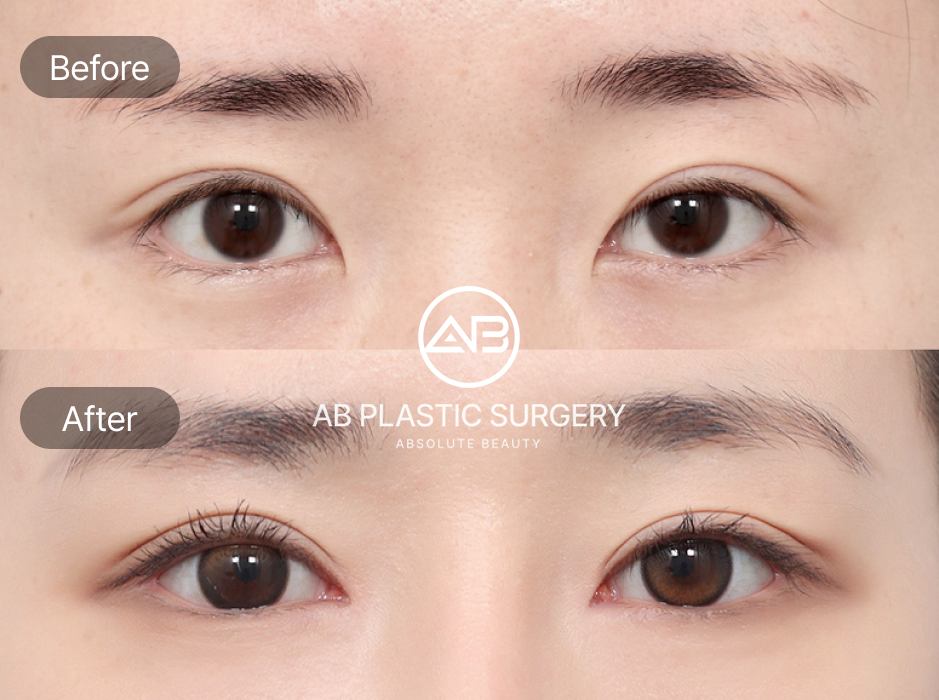 目尻切開・目下切開のビフォーアフター写真。AB美容外科韓国の症例で横幅や縦幅を拡大し、自然でバランスの良い目元を実現