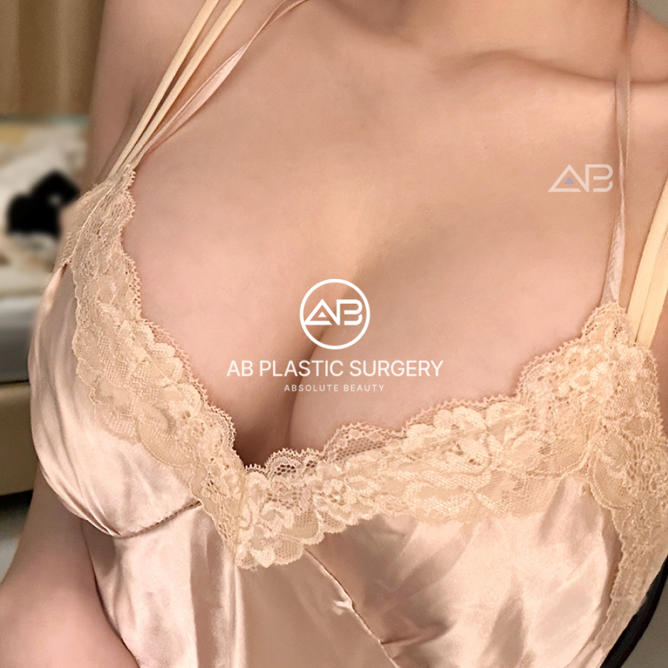 韓国美容ツアー 豊胸手術 シリコンインプラント 自然な仕上がり 前後写真 AB美容外科韓国