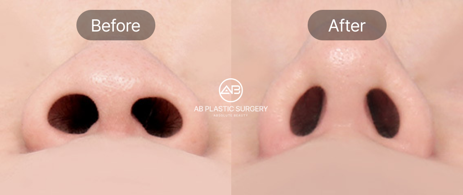 小鼻縮小 内側切開法の前後写真、鼻の穴を内側から切開し幅を狭め自然な仕上がりを実現したAB美容外科韓国の症例
