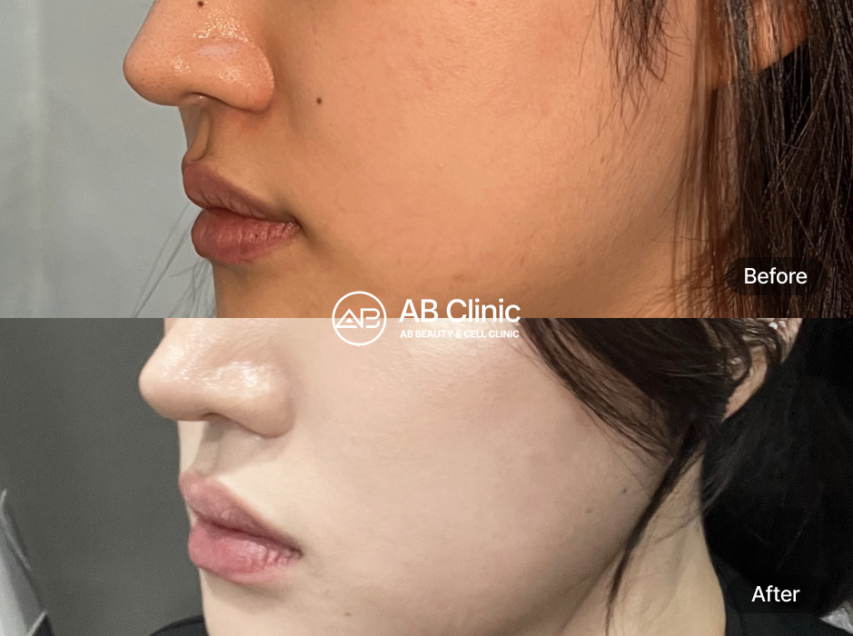 韓国美容ツアー 美容皮膚科 リジュラン注射 肌再生 効果 前後写真 AB美容外科韓国