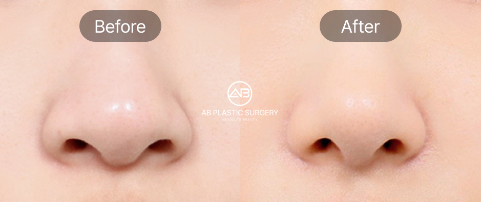 小鼻縮小 外側切開法の前後写真、鼻翼の外側を切開し横に広がった小鼻を改善したAB美容外科韓国の症例