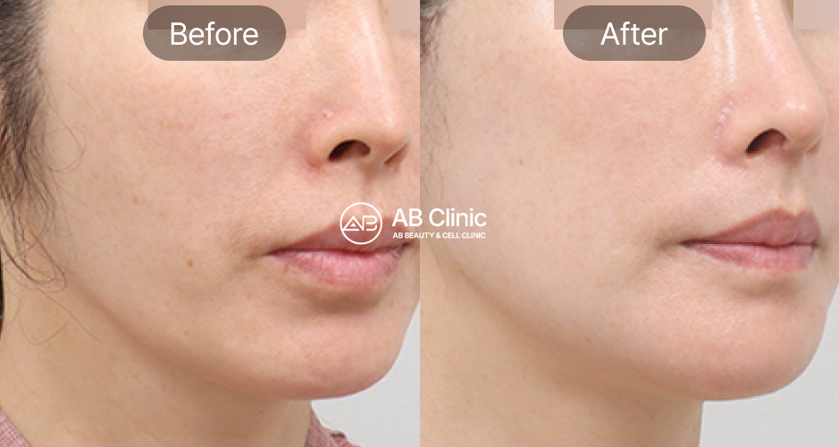 韓国美容ツアー 美容皮膚科 サーマクールFLX 高周波リフトアップ 効果 前後写真 ABクリニック