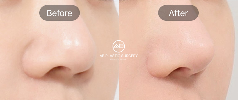 小鼻縮小 内外併用法の前後写真、内側切開と外側切開を組み合わせ小鼻全体の広がりを改善したAB美容外科韓国の症例