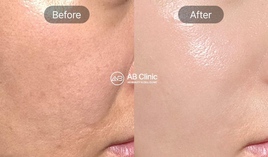 韓国美容皮膚科 ABクリニック サーマクール Thermage 前後写真 肌のハリと弾力改善 コラーゲン再生による若返り効果