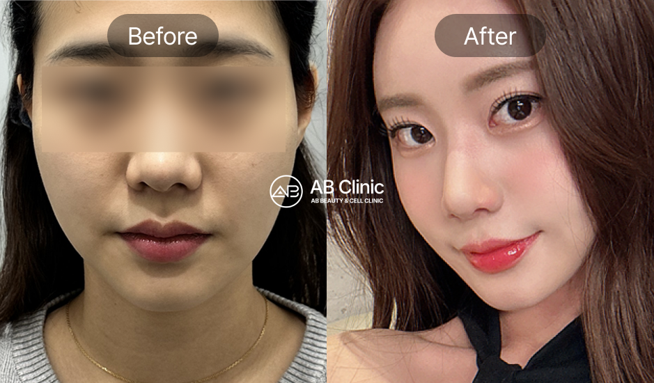 韓国美容ツアー 美容皮膚科 サーマクールFLX 高周波リフトアップ 効果 前後写真 ABクリニック