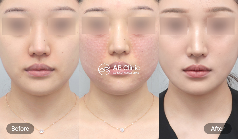 韓国美容皮膚科 ABクリニック リジュラン注射 サーモン注射 前後写真 肌のハリ改善とキメの回復 小じわや乾燥肌ケア