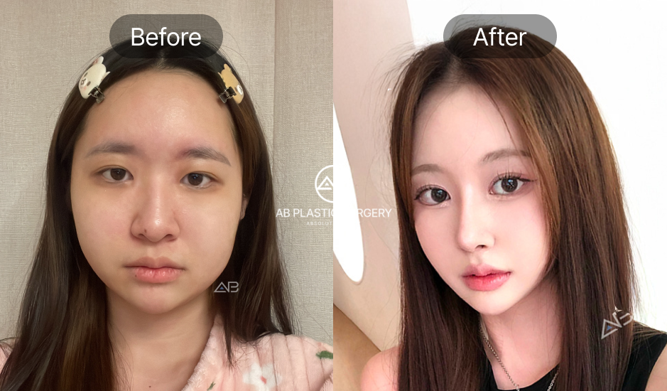 目尻切開・目下切開のビフォーアフター症例写真。AB美容外科韓国で目の横幅と縦幅を広げ、顔全体のバランスが整い明るい印象の目元に改善