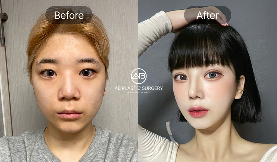 小鼻縮小の前後写真、過度な縮小を避け自然な仕上がりとバランスを実現したAB美容外科韓国の症例