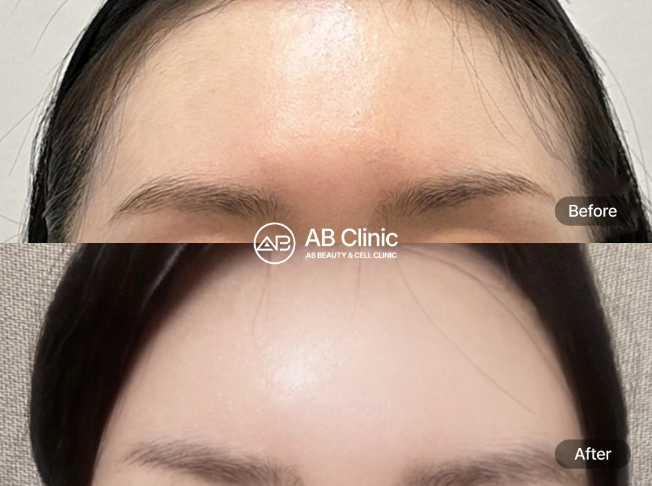 韓国美容皮膚科 ABクリニック ボトックス フィラー ヒアルロン酸 前後写真 額のシワ改善と自然なボリュームアップ 人気施術