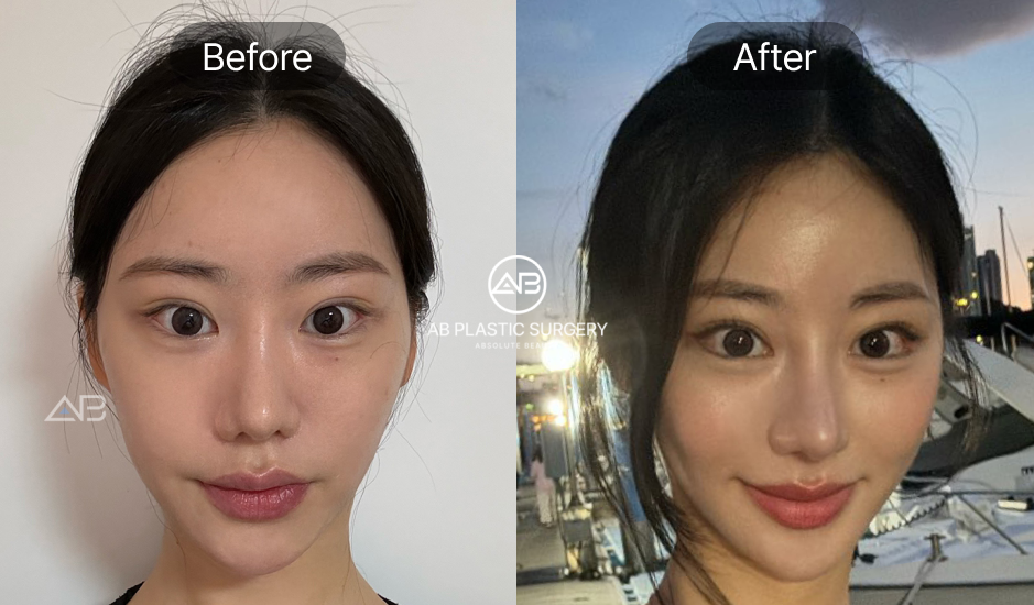 目尻切開のビフォーアフター症例写真。AB美容外科韓国で横ラインを広げ、自然でバランスの取れた大きな目元に改善