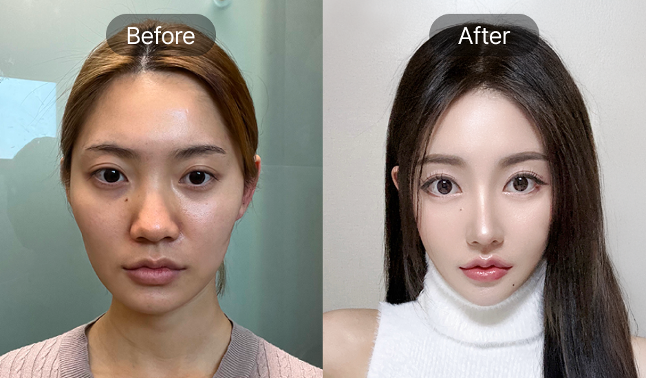 韓国美容整形 AB美容外科韓国 二重整形 ビフォーアフター 前後写真 一重から自然な二重に変化した症例 日本人にも人気