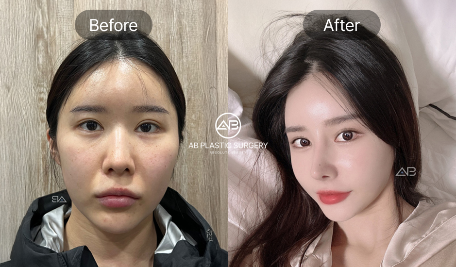 目下切開のビフォーアフター症例写真。AB美容外科韓国で縦ラインを広げ、優しく女性らしい印象の目元に改善