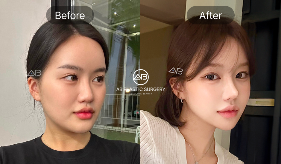 韓国美容整形 AB美容外科韓国 隆鼻術 鼻整形 前後写真 自然な鼻筋デザインと顔全体のバランス改善 症例