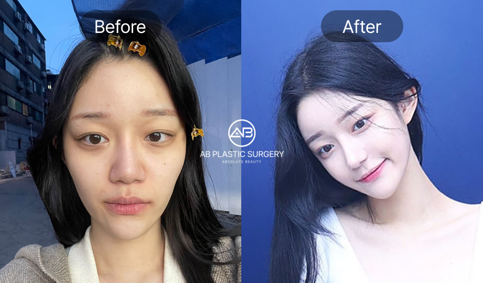韓国美容整形 AB美容外科韓国 輪郭整形 小顔矯正 ビフォーアフター 前後写真 Vライン矯正と小顔効果が分かる症例