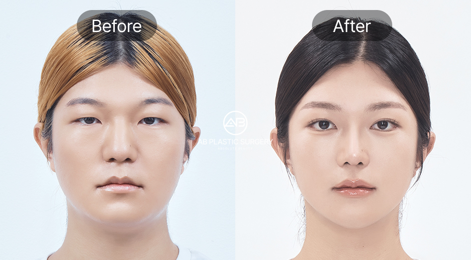韓国AB美容外科のエラ張り改善ビフォーアフター写真、セルフケアやボトックスでは難しい骨格矯正効果