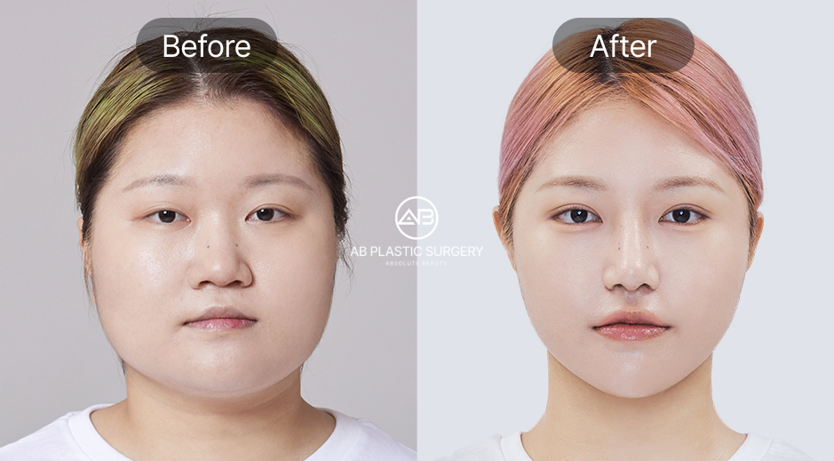 韓国AB美容外科のエラ削り手術ビフォーアフター写真、小顔効果とVライン形成の実例
