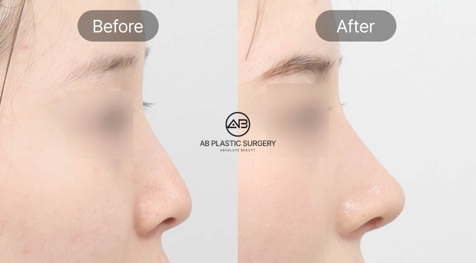 韓国AB美容外科の団子鼻整形ビフォーアフター写真 耳介軟骨移植や鼻尖縮小による鼻先改善効果を示す症例画像