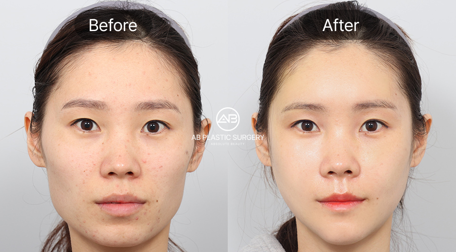 韓国AB美容外科の輪郭3点手術ビフォーアフター写真、顎先形成と頬骨縮小を含む小顔整形効果