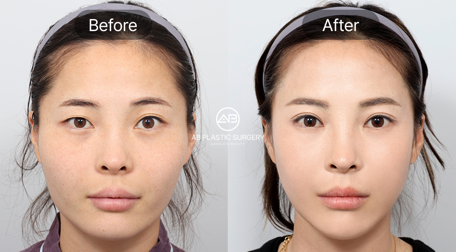 韓国AB美容外科の輪郭整形ビフォーアフター写真、エラ削りと輪郭3点手術による小顔効果症例