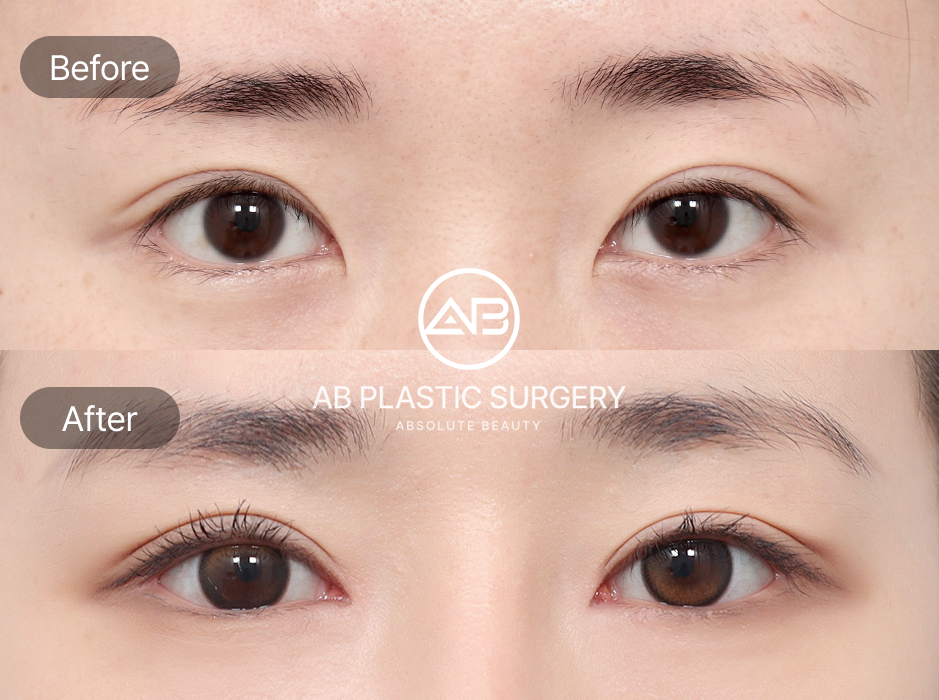 韓国AB美容外科による切れ長の目整形のビフォーアフター写真