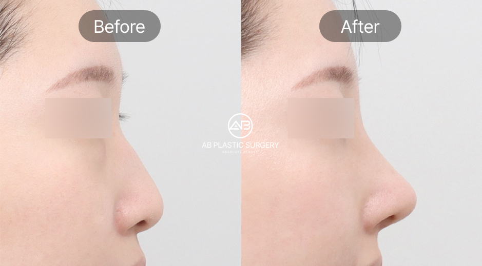 鼻尖形成 ビフォーアフター 団子鼻 改善 韓国AB美容外科 自然な鼻先整形 横顔の変化