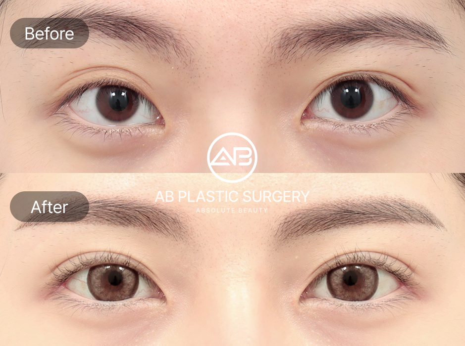 目尻切開と下眼瞼下制によって、切れ長の美しい目元を完成させたAB美容外科韓国の整形ビフォーアフター写真です