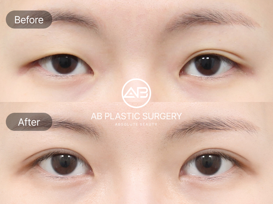 韓国AB美容外科 切開法 二重整形 厚いまぶた改善 自然な二重ライン 永久二重デザイン 前後写真