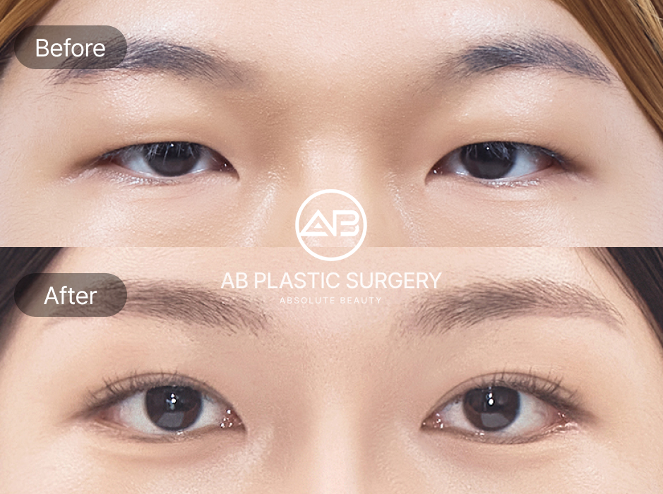 目整形ビフォーアフター｜切れ長の目整形・目尻切開・下眼瞼下制｜AB美容外科韓国