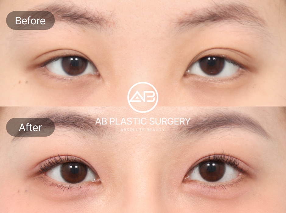 韓国AB美容外科 下眼瞼下制術 タレ目形成 優しい目元 白目拡大 目の形改善 デザイン調整 前後写真