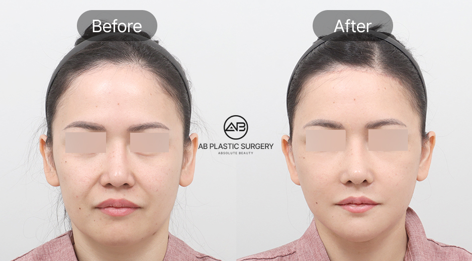 フルSMASリフト＋首リフト＋額リフト＋額縮小術＋顔の脂肪移植のビフォーアフター写真