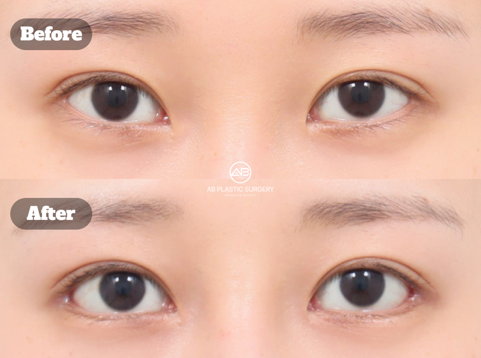 韓国のAB美容外科における目尻切開・下眼瞼下制術の美容整形手術ビフォーアフター