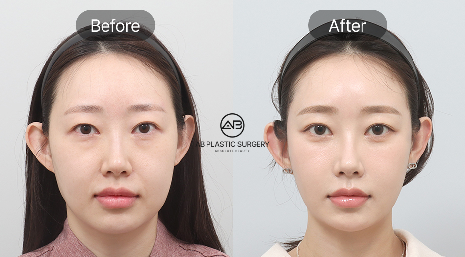 クイックミニリフト＋脂肪移植＋目の下脂肪再配置 のビフォーアフター写真