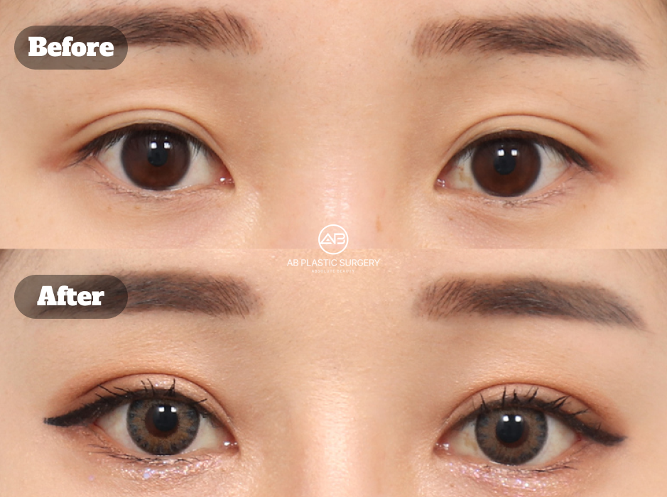 韓国で埋没法による二重整形と目尻切開・下眼瞼下制術を組み合わせた術前術後結果