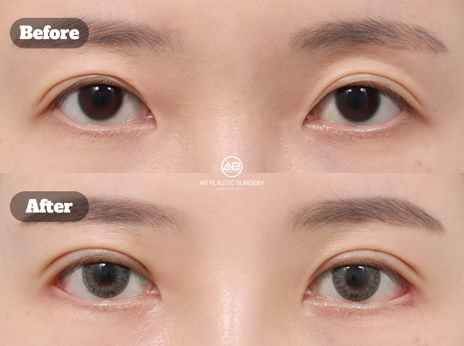 埋没法二重の修正を目的に再手術と目尻切開・下眼瞼下制術を行ったケース