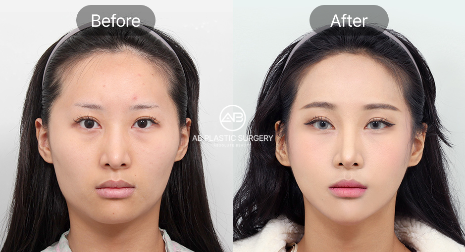 韓国で輪郭整形をする場合のビフォーアフターは？AB美容外科によるエラ削り・頬骨縮小・顎先形成の症例」