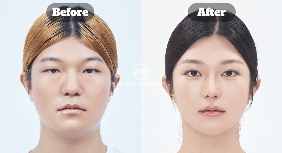 顔全体のバランスを考慮し、希望に合わせて計画した顎整形のビフォーアフター画像