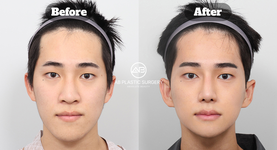 韓国のエラ削り縮小・顎先整形・鼻整形のビフォーアフター体験レビュー