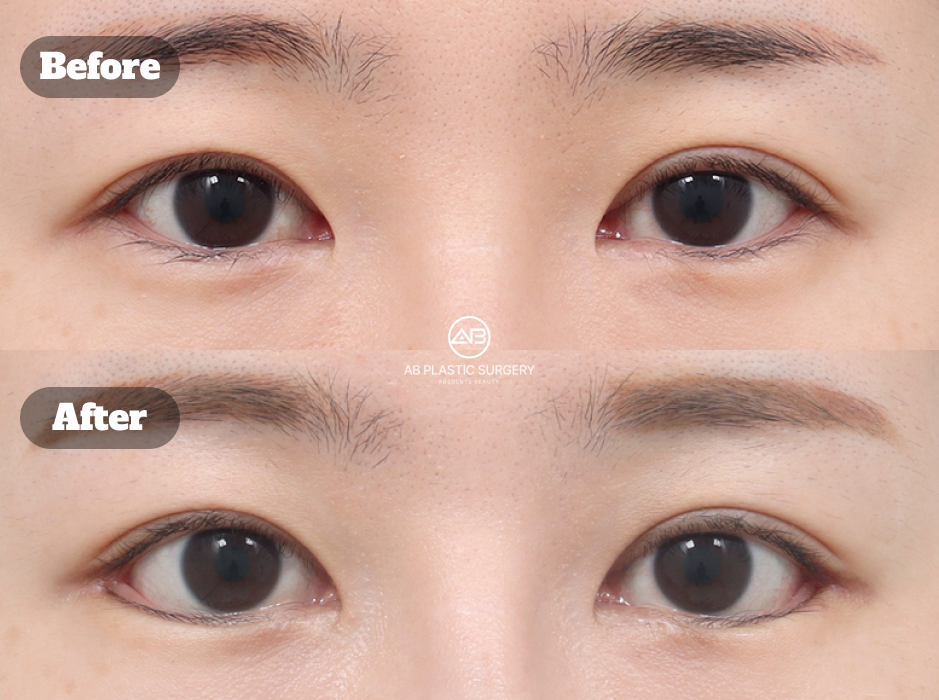 韓国で行った目尻切開と下眼瞼下制術の手術前後写真