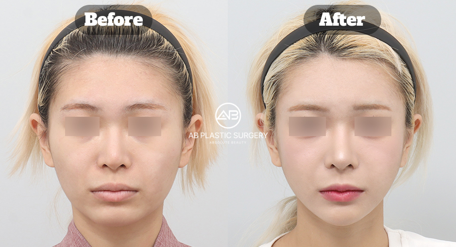 ミニVライン形成と通常のVライン顎整形の違いを比較したビフォーアフター画像