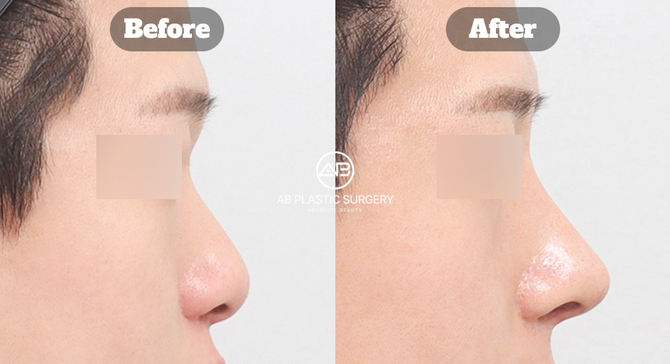 韓国の男性鼻整形・団子鼻整形による鼻ライン変化のレビューイメージ｜AB美容外科韓国
